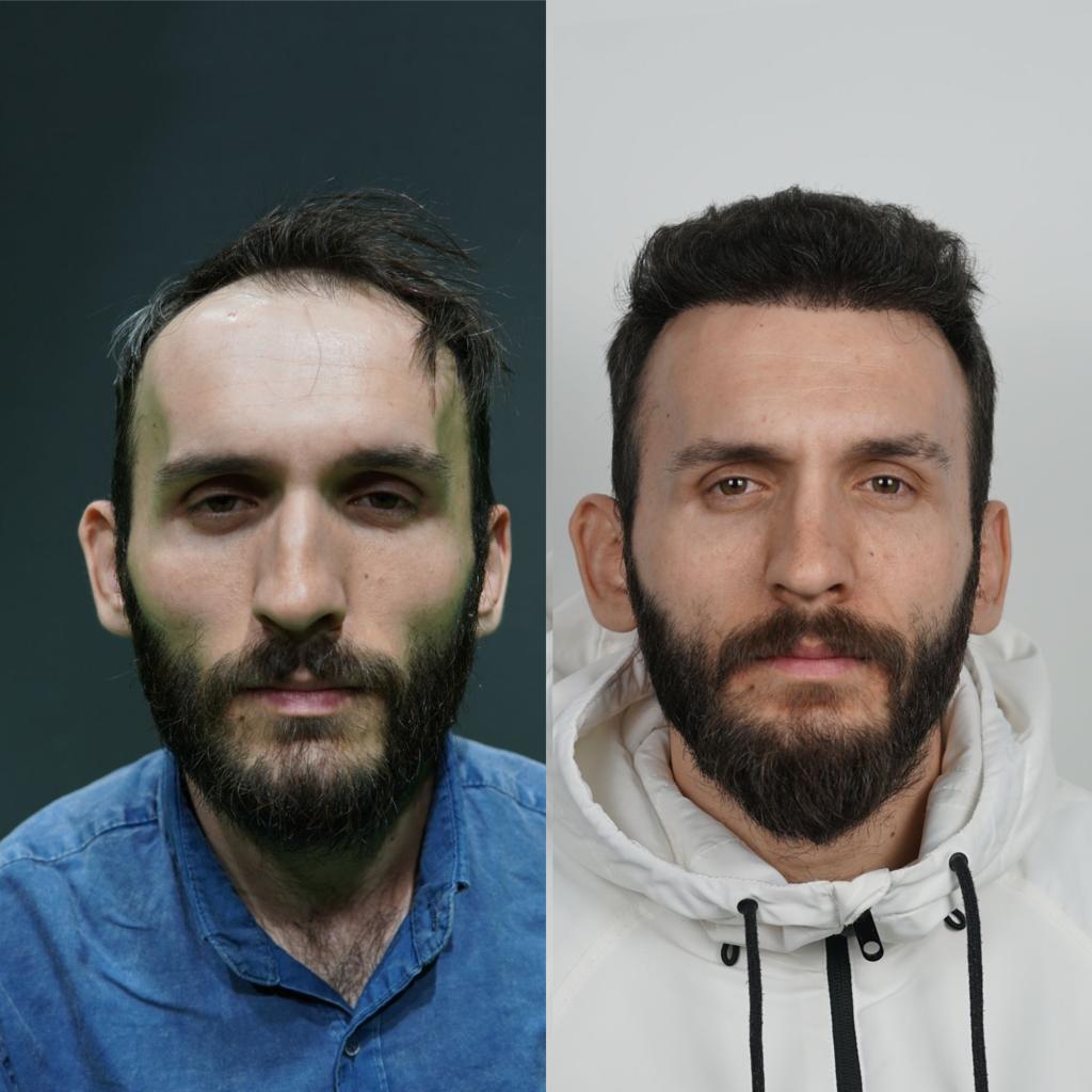 prima e dopo trapianto capelli 20